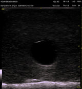 Ultrasound Deep Vein Thrombosis (DVT) Phantom Trainer