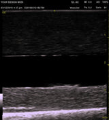 Ultrasound Deep Vein Thrombosis (DVT) Phantom Trainer